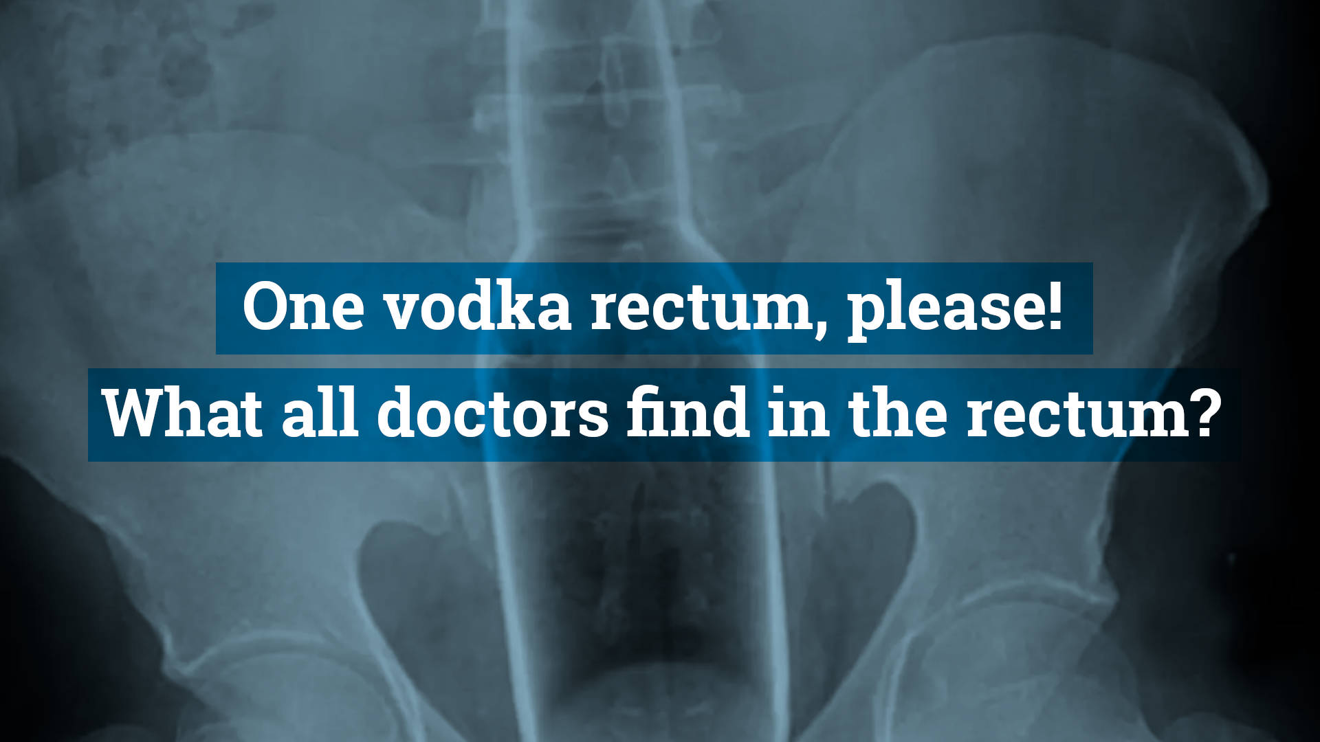 One vodka rectum, please! What all doctors find in the rectum? We compiled a list of the strangest objects in the anus